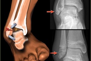 How To Treat An Ankle Fracture